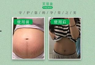 明星网红长妊娠纹,揭秘明星网红如何应对妊娠纹